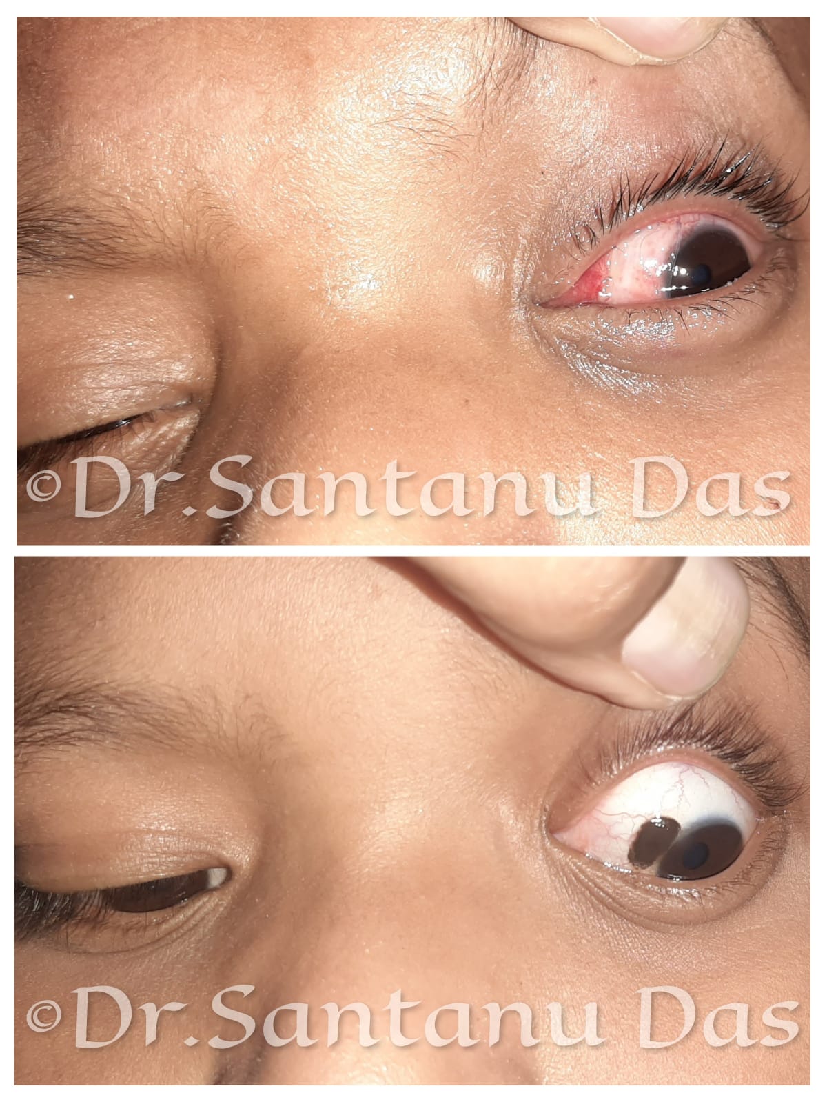 Ocular Surface Lesion